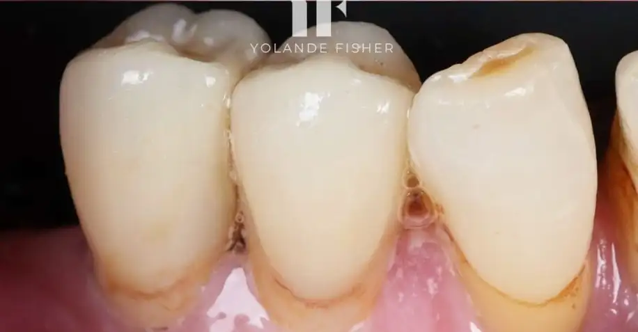 After Composite Bonding